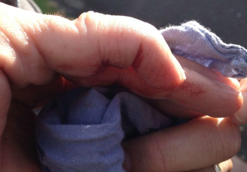 Dislocated finger: What to do plus symptoms, causes, and treatment