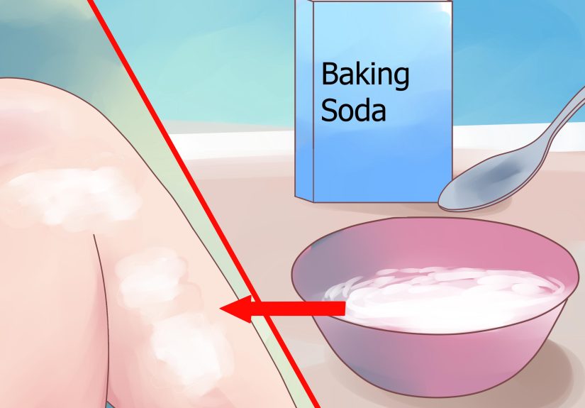 How to Treat Shingles (Herpes Zoster): 15 Steps