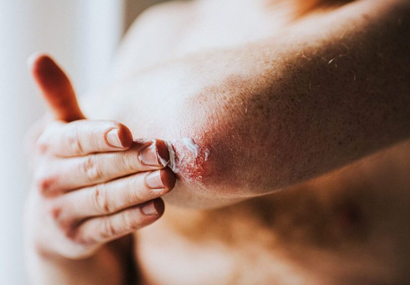 Pustular Psoriasis: Diagnosis, Types, Treatment, and More