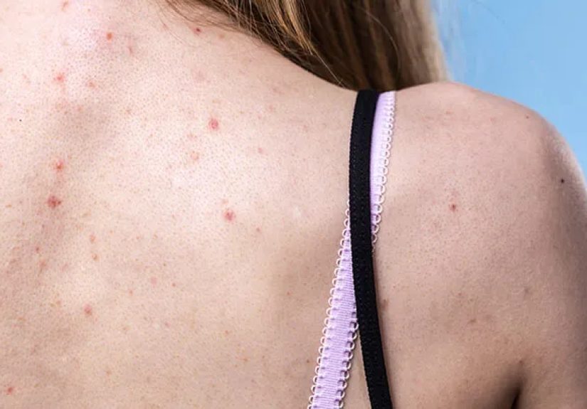 Back Acne (‘Bacne’) 101: Types, Prevention, and Treatment