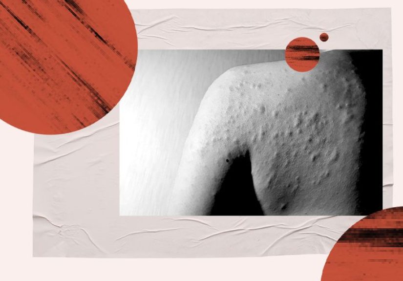 Cholinergic urticaria: Symptoms, treatment, and causes