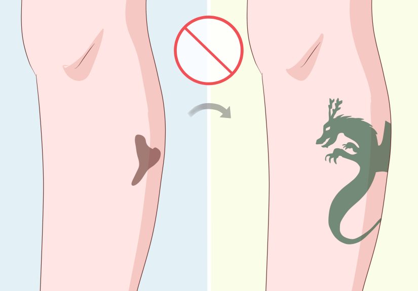 How to Lighten Birthmarks: Can Natural Remedies Help?