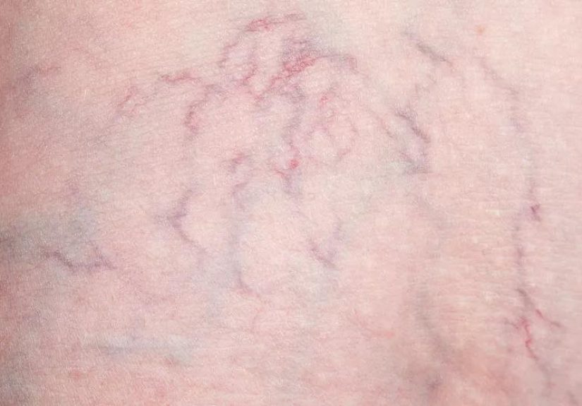 How Varicose and Spider Veins Are Different
