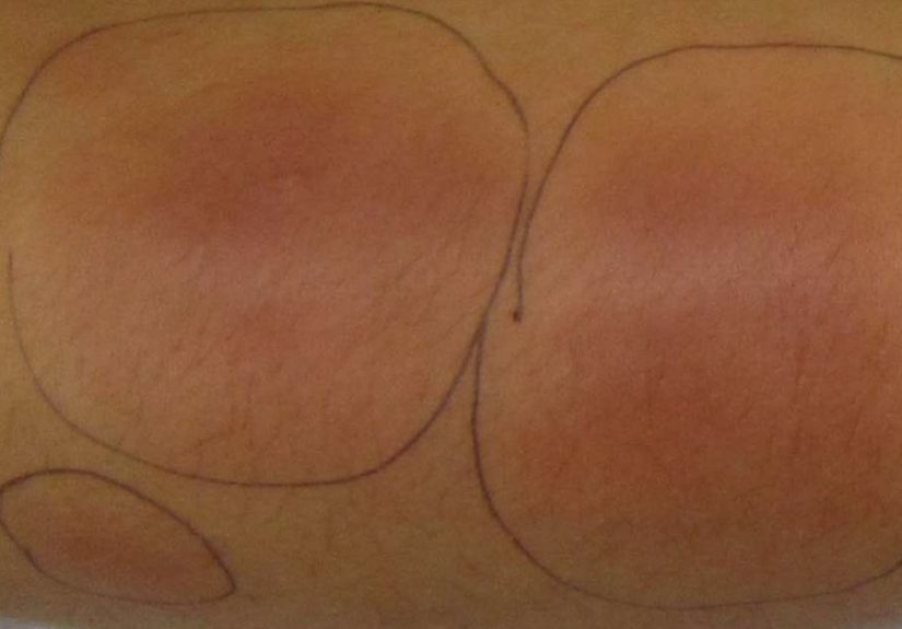 Panniculitis: Symptoms, Types, and Treatment