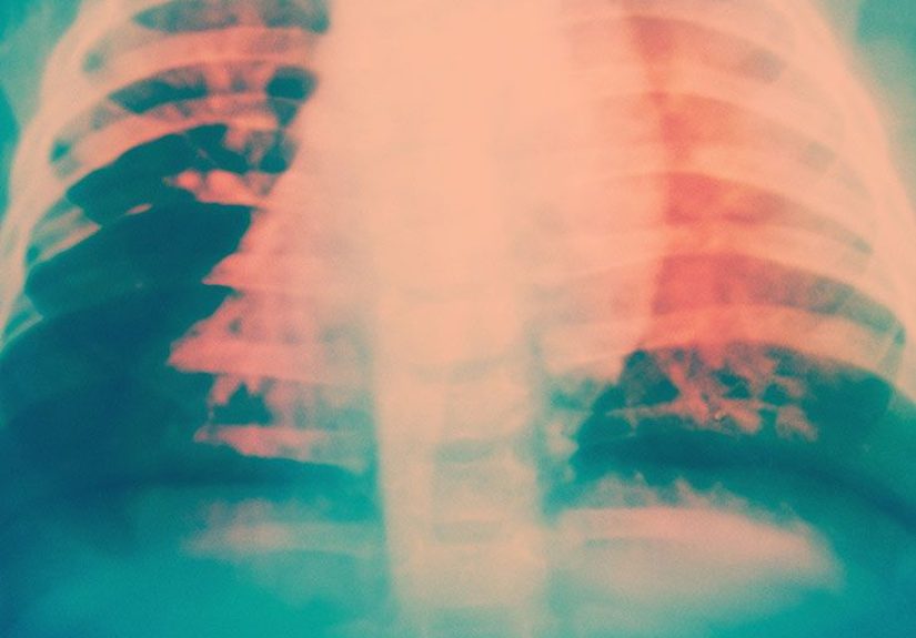 Pulmonary hypertension diagnosis: Tests, criteria, what to expect