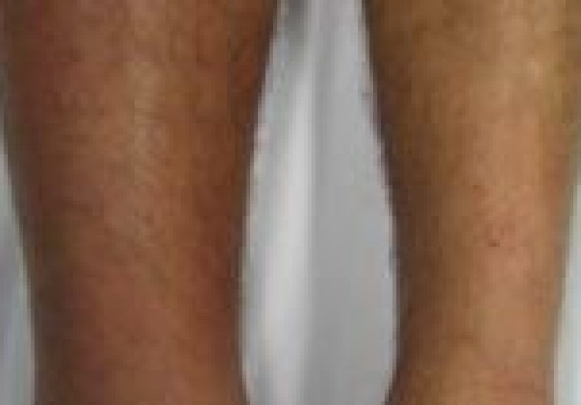 Thrombophlebitis: Causes, Symptoms, and Diagnosis