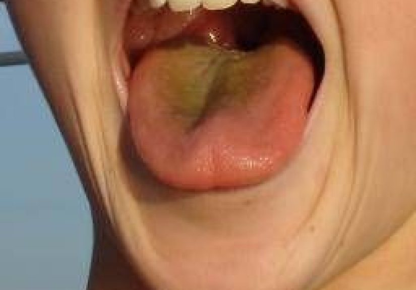 Yellow Tongue: Causes, Treatments, and When to See a Doctor