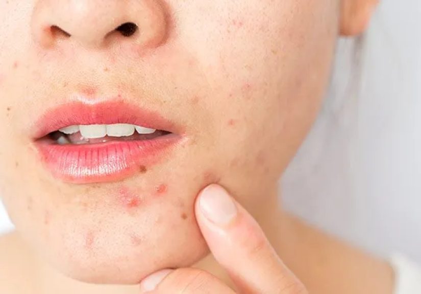 Adult Acne: 10 Surprising Causes (and How to Get Rid of It)