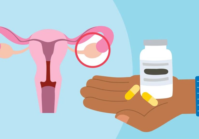 Berberine for PCOS: Benefits and Risks