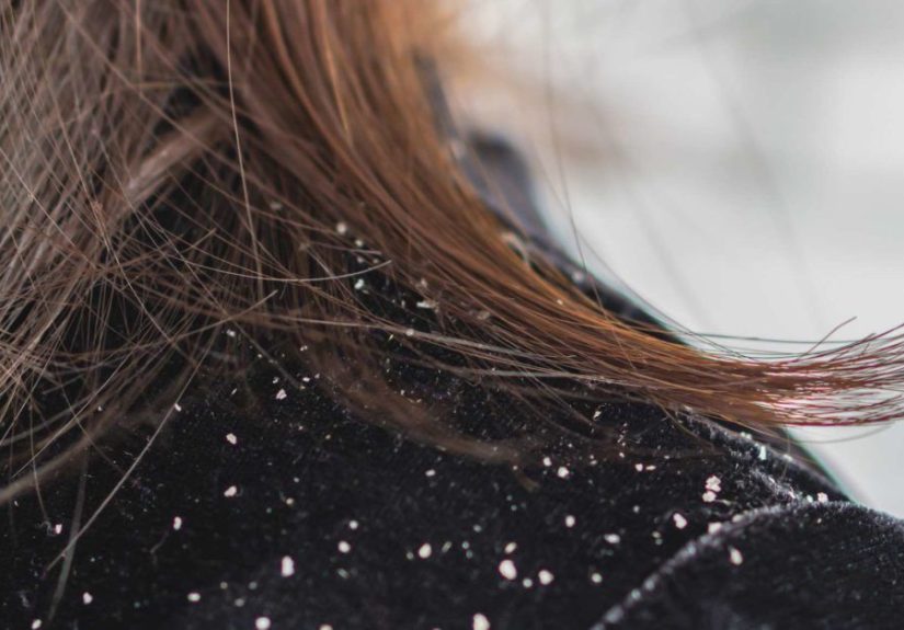 Can dandruff lead to hair loss? The link, causes, and treatments