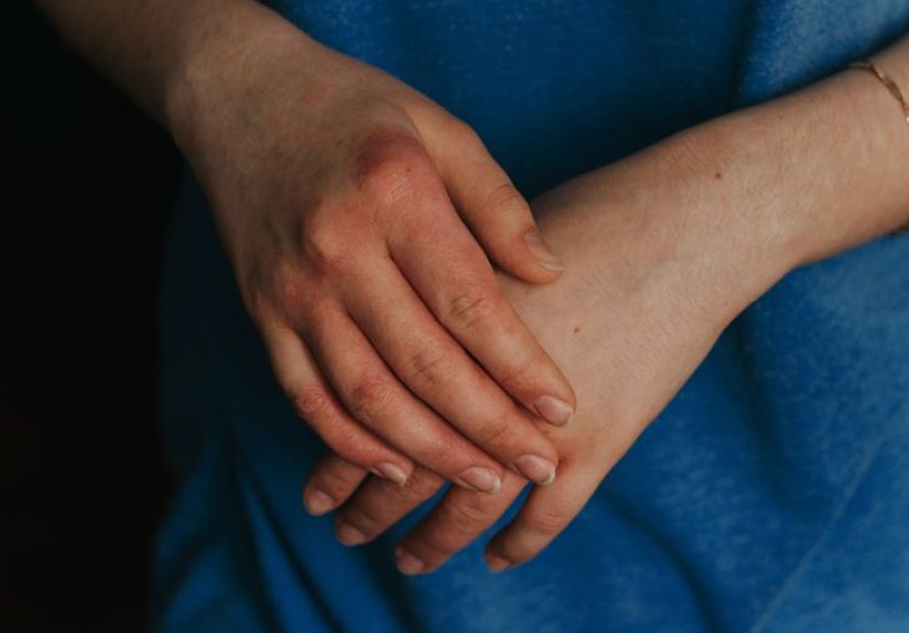 Eczema on Hands and Fingers: Symptoms, Causes, and More