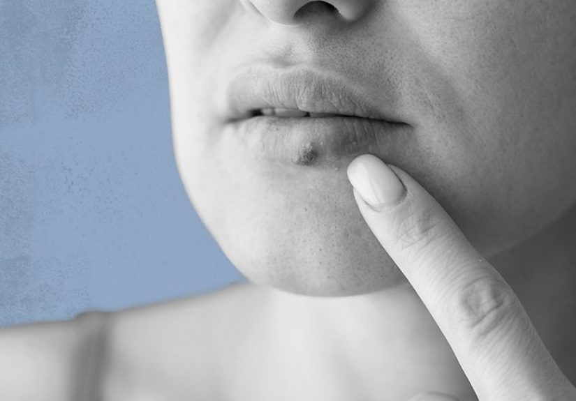 How to get rid of a cold sore quickly: Treatments and remedies