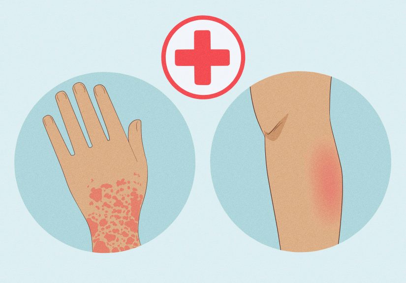 How to Get Rid of Pimples on Your Pubic Area (for Males)