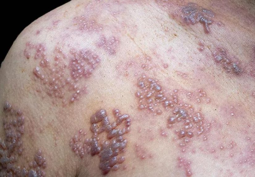 How To Protect Yourself Against Shingles