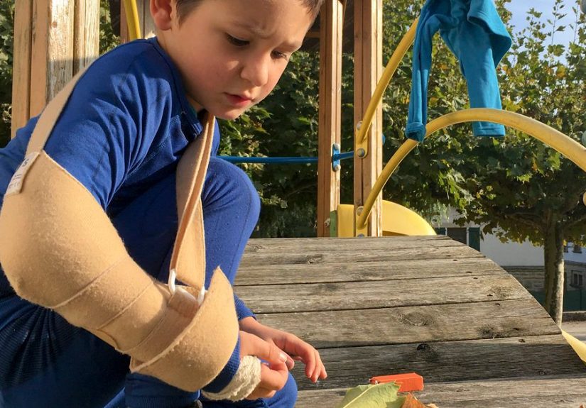 Humerus Fracture: Types, Causes, Treatment, and Healing Time