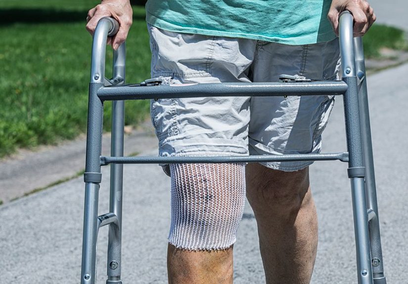 Knee Replacement Recovery Time: What to Expect in the First 12 Weeks