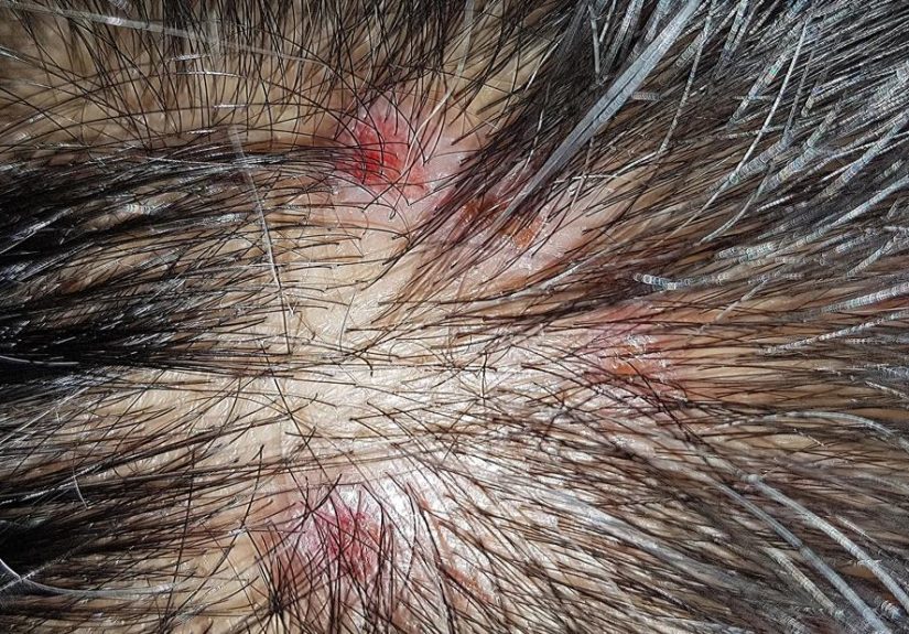Scabs on Scalp? Why You Have Them and How To Treat