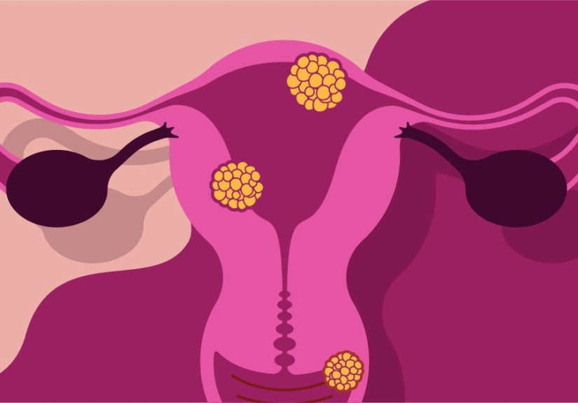 Ways to Treat and Prevent Bacterial Vaginosis