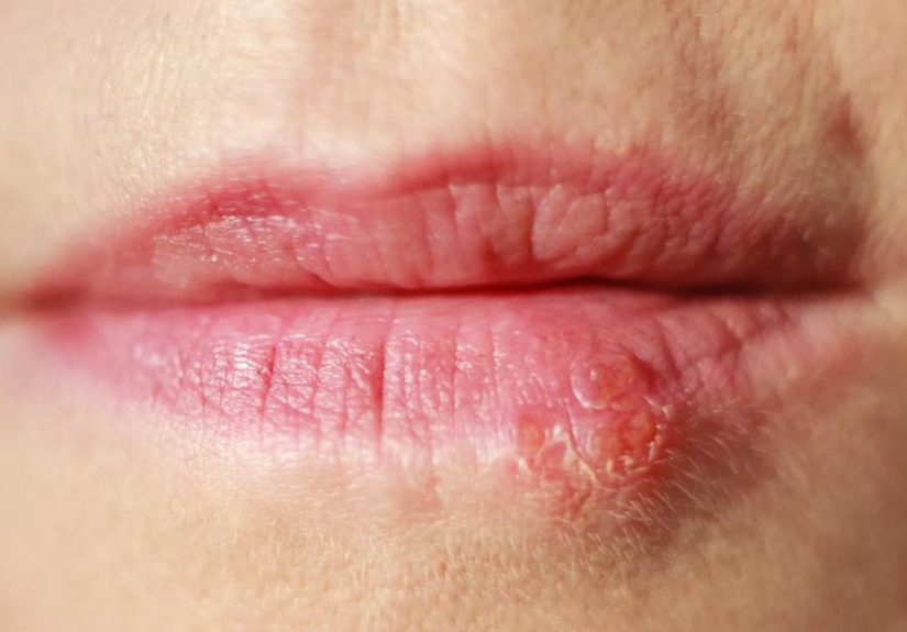 What Triggers Cold Sores?