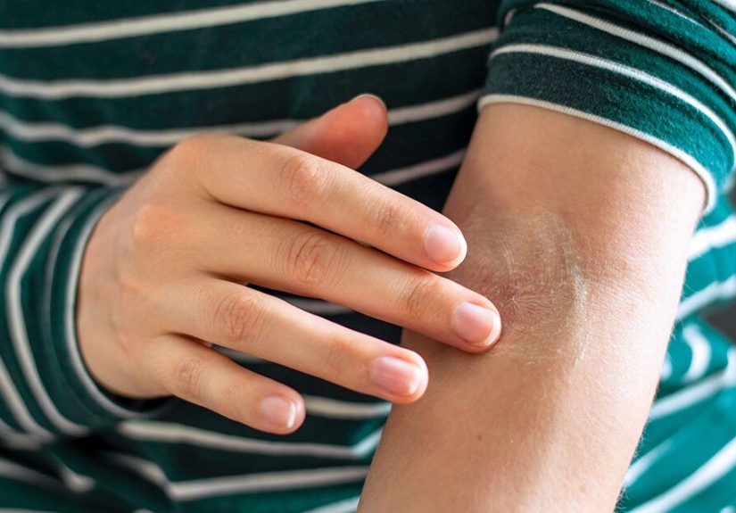 3 Homemade Cream Recipes for Eczema Relief