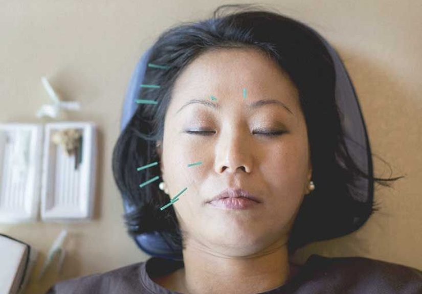 Acupuncture for Headaches and Migraine: How It Works