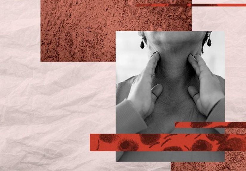 Anaplastic thyroid cancer: Symptoms, treatment, survival, and more