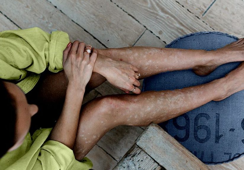 Brote de psoriasis durante el perÃ­odo, causas y remedios