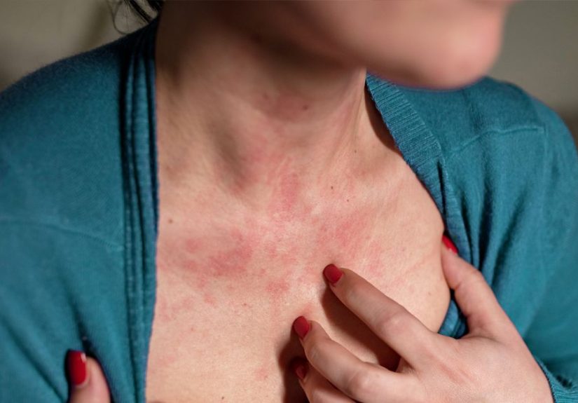 Eczema vs. Hives: Similarities, Differences, Treatment, and More