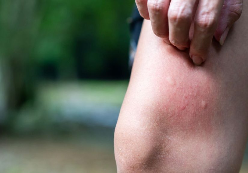 Fleabites: Symptoms, Images, Treatments, and More
