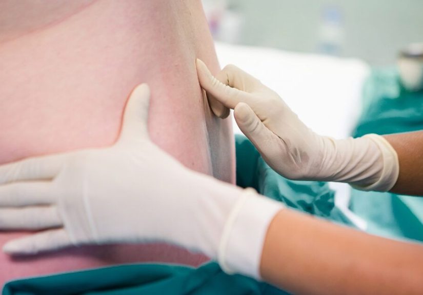 How Long Does an Epidural Last?