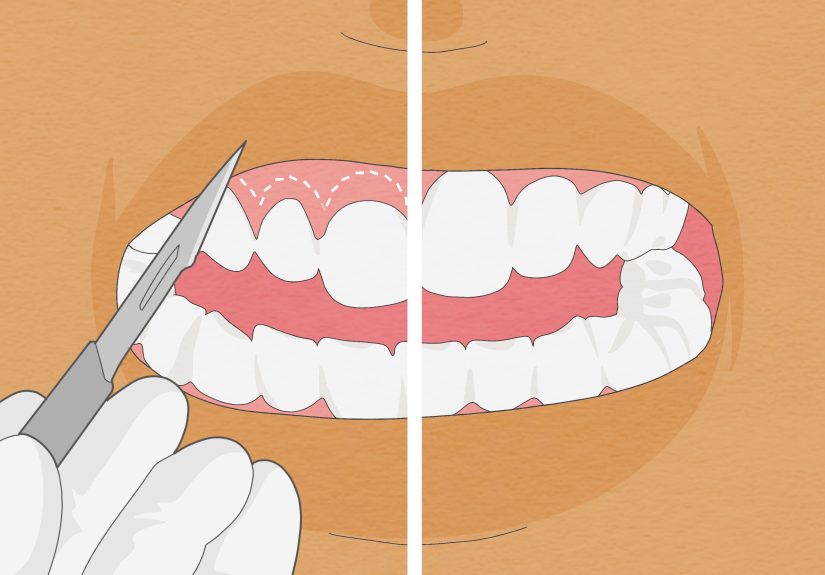 How to Straighten Your Teeth Without Braces: 10 Alternatives