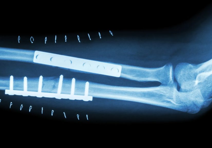 ORIF Surgery: When It’s Needed and How It’s Done