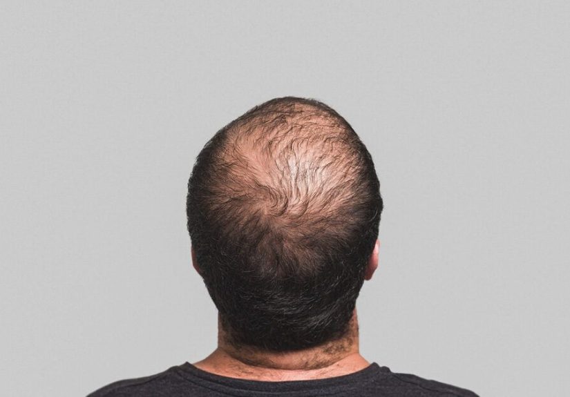 PRP for Hair Loss: Efficacy, Safety, and Cost