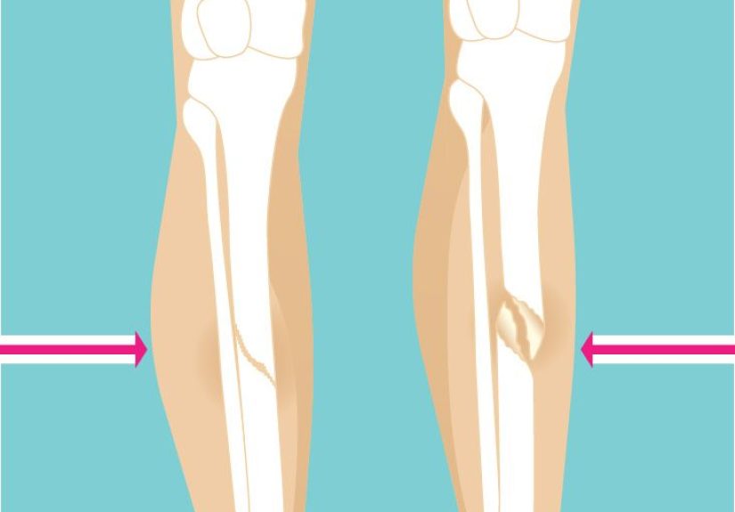 Spiral Fracture: Healing Time, Tibia, and Fibula