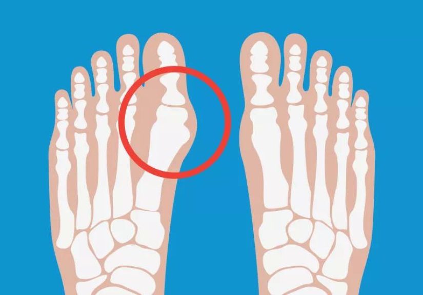 When Should I Have Surgery for My Bunions?