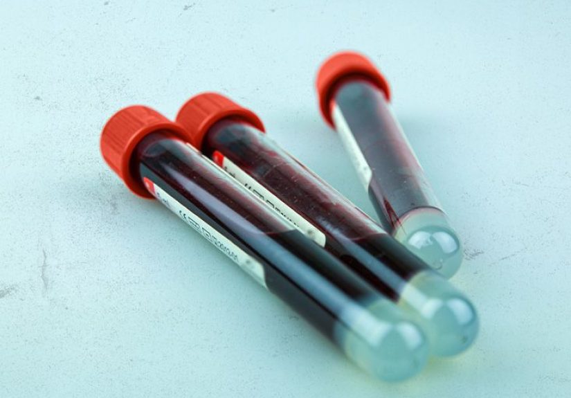 Blood Test for Prostate Cancer: PSA Test Explained