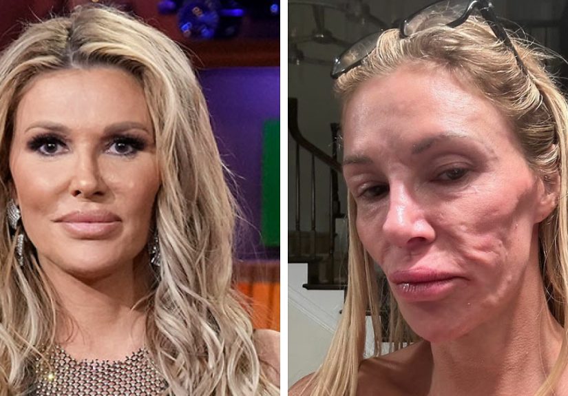 Brandi Glanville Finally Receives Diagnosis For Facial Disfigurement After Blaming A Parasite