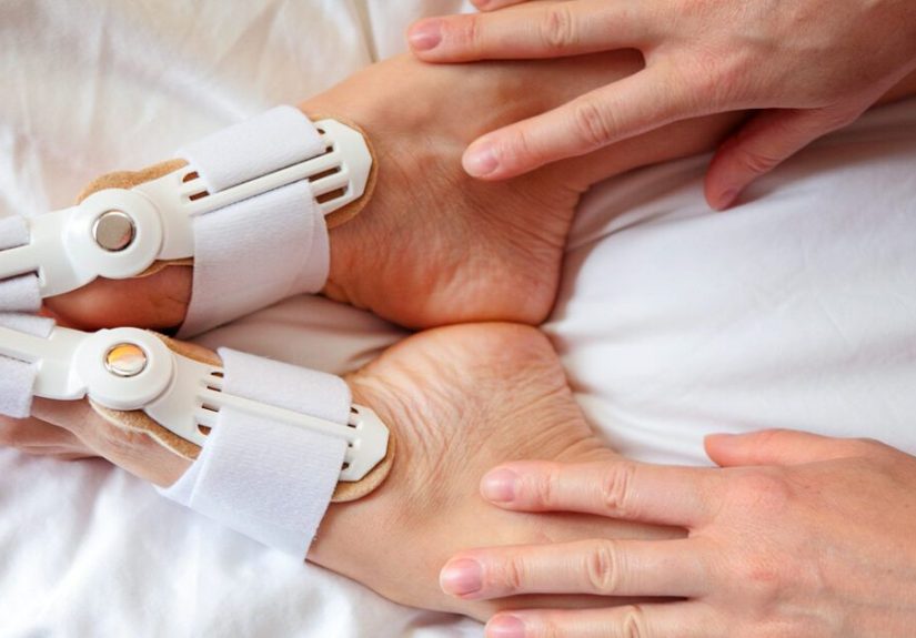 Do Bunion Correctors Work to Treat Pain, Realign Toe Joints?