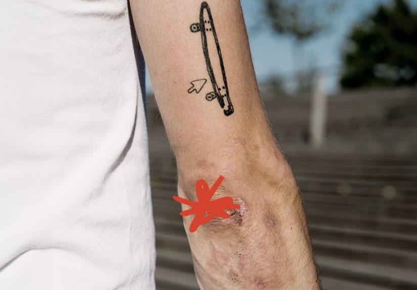 Elbow Joint Effusion: Meaning, Treatment, and Recovery