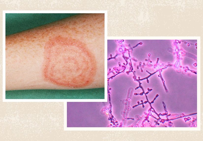 First Cases of Drug-Resistant Ringworm Found in U.S.