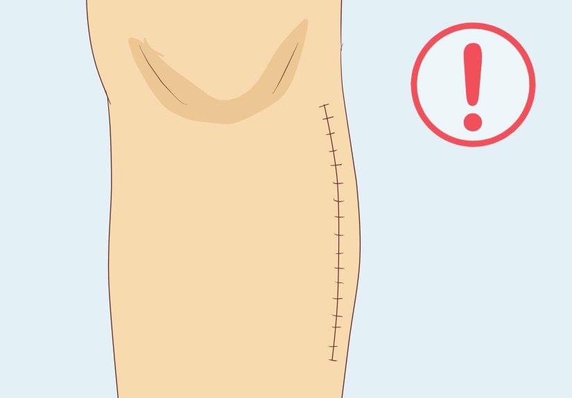 Gout: How to Recognize the Symptoms and Risk Factors