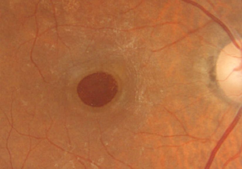 Macular Hole: Diagnosing and Treating This Tricky Eye Problem