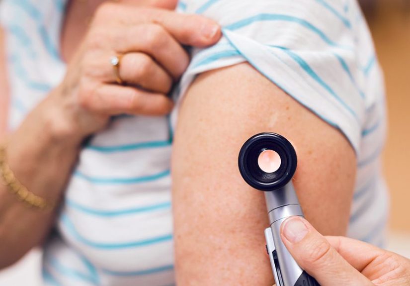 Medicare and Mole Removal: What's Covered?