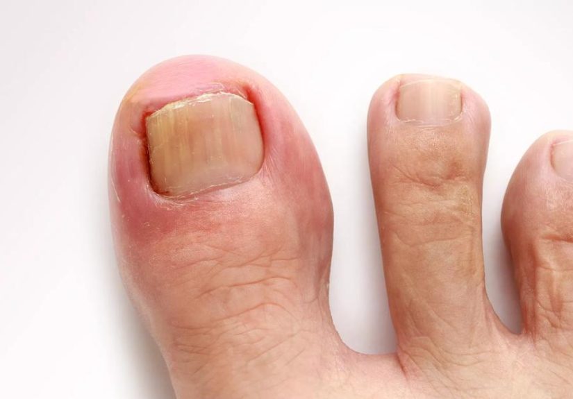 Remedies for Getting Rid of Ingrown Toenails
