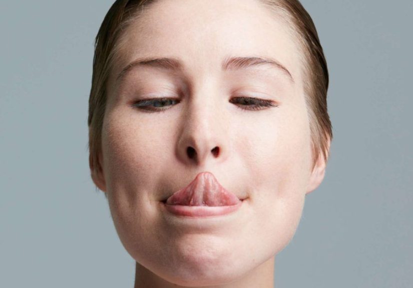 Scalloped tongue: Causes, symptoms, and treatment