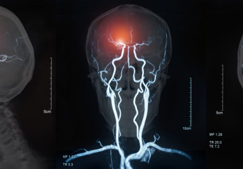 Suspect a stroke? Act F.A.S.T.