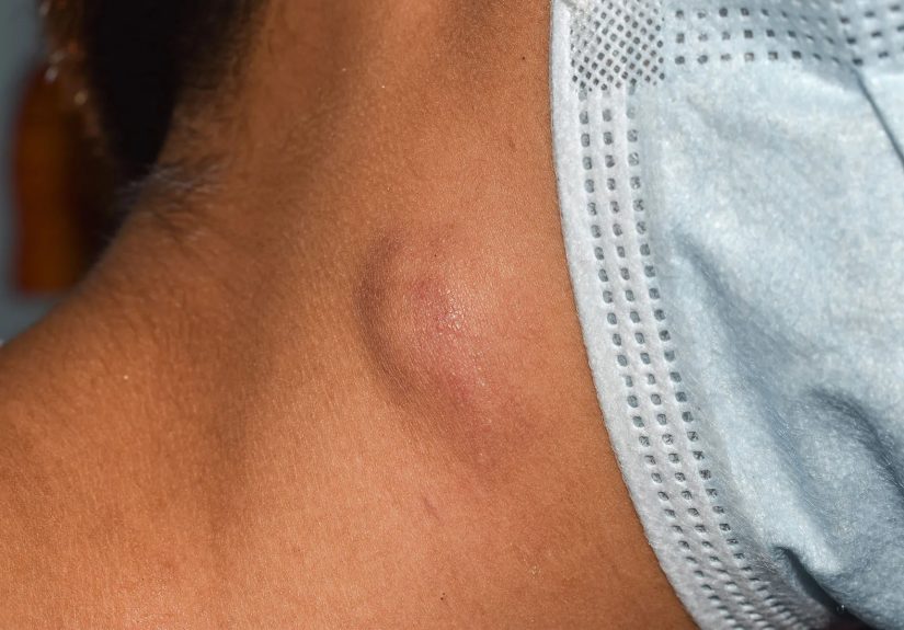 What Is B-Cell Lymphoma?