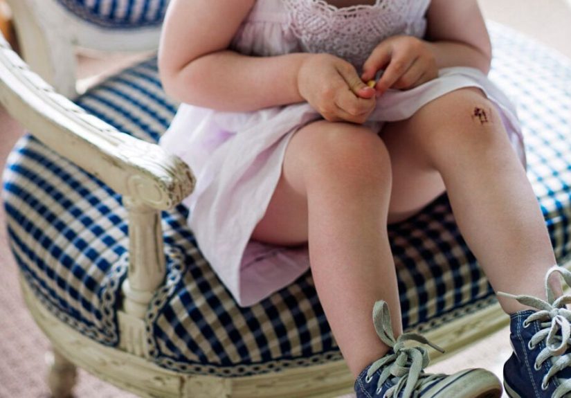 Yellow Scab: Causes, Appearance, and Treatment Options